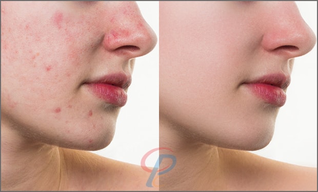 Acne and Scars Retouchup