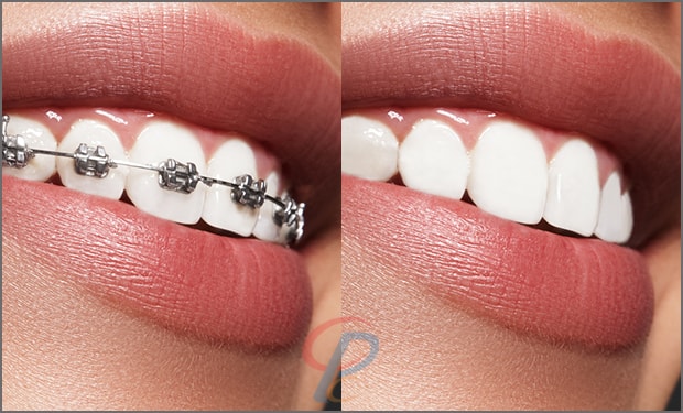 Braces Removal Services