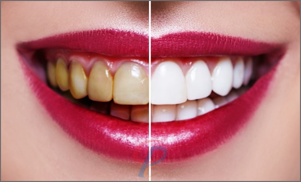 Teeth Whitening