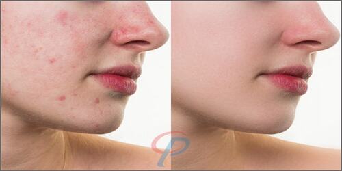 Acne and Scars Retouch up